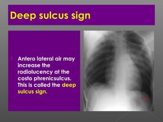  Antero lateral air may
increase the
radiolucency at the
costo phrenicsulcus.
This is called the deep
sulcus sign.
 