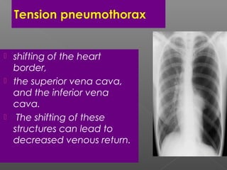  shifting of the heart
border,
 the superior vena cava,
and the inferior vena
cava.
 The shifting of these
structures can lead to
decreased venous return.
 