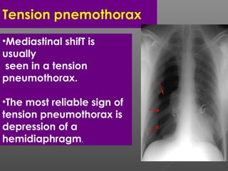 •Mediastinal shifT is
usually
seen in a tension
pneumothorax.
•The most reliable sign of
tension pneumothorax is
depression of a
hemidiaphragm.
 
