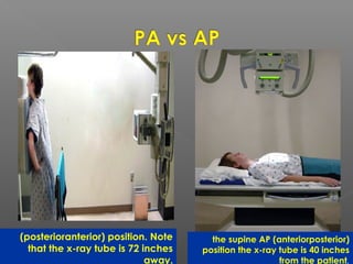  (posterioranterior) position. Note
that the x-ray tube is 72 inches
away.
the supine AP (anteriorposterior)
position the x-ray tube is 40 inches
from the patient.
 