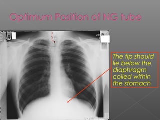 The tip should
lie below the
diaphragm
coiled within
the stomach
 