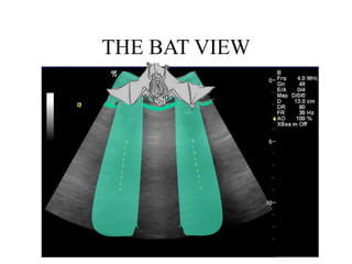 THE BAT VIEW
Chest wall
Pleural line
 