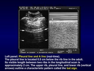 Normal lung surface
Left panel: Pleural line and A line (real-time).
The pleural line is located 0.5 cm below the rib line in the adult.
Its visible length between two ribs in the longitudinal scan is
approximately 2 cm. The upper rib, pleural line, and lower rib (vertical
arrows) outline a characteristic pattern called the bat sign.
 