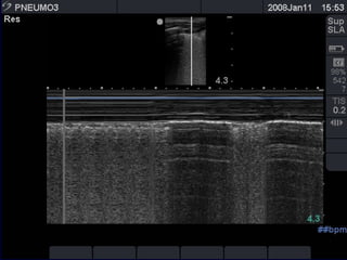 the "seashore sign" (Fig.3).
 