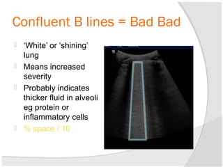 Confluent B lines = Bad Bad
 ‘White’ or ‘shining’
lung
 Means increased
severity
 Probably indicates
thicker fluid in alveoli
eg protein or
inflammatory cells
 % space / 10
 
