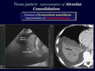 Tissue pattern representative of Alveolar
Consolidation
Presence of hyperechoic punctiform
images
Presence of hyperechoic punctiform
imagesrepresentative of air bronchogramsrepresentative of air bronchograms
Pleural
effusion
Lower lobe
 