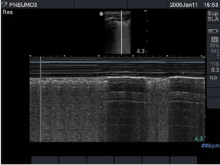the "seashore sign" (Fig.3).
 