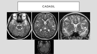 Imaging in Dementia - A Primer for neuroradiologists | PPTX