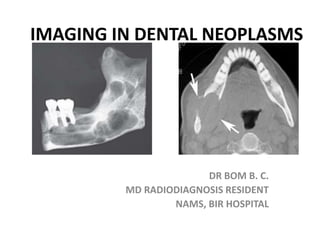 IMAGING IN DENTAL NEOPLASMS
DR BOM B. C.
MD RADIODIAGNOSIS RESIDENT
NAMS, BIR HOSPITAL
 