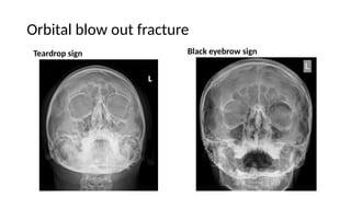Tear Sign Imaging in Dentistry opg cbct cone beam ct | PPTX