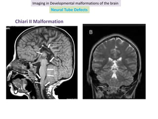 Imaging in developmental malformations of the brain | PPTX