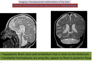 Posterior Float Imaging in developmental malformations of the brain | PPTX