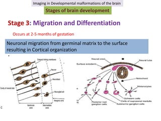 Imaging in developmental malformations of the brain | PPTX