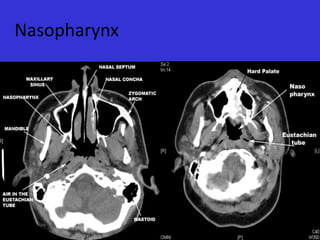Nasopharynx

 