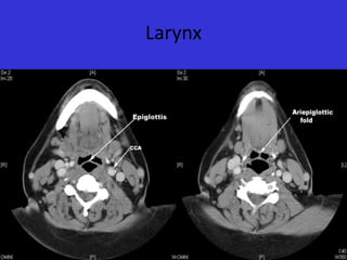 Larynx

 