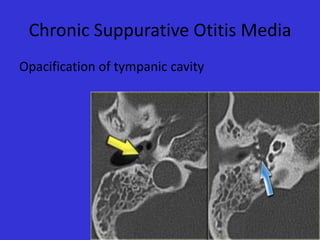 Chronic Suppurative Otitis Media
Opacification of tympanic cavity

 