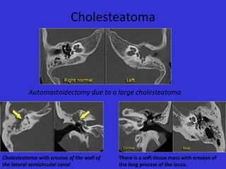 Cholesteatoma

Automastoidectomy due to a large cholesteatoma

Cholesteatoma with erosion of the wall of
the lateral semicircular canal

There is a soft tissue mass with erosion of
the long process of the incus.

 