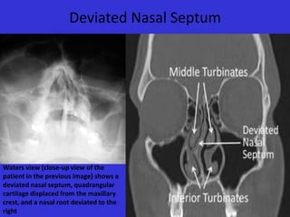 Deviated Nasal Septum

Waters view (close-up view of the
patient in the previous image) shows a
deviated nasal septum, quadrangular
cartilage displaced from the maxillary
crest, and a nasal root deviated to the
right

 