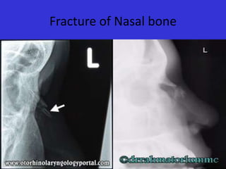 Fracture of Nasal bone

 