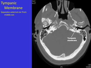 Tympanic
Membrane
Separates external ear from
middle ear.

 
