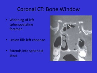 Coronal CT: Bone Window
• Widening of left
sphenopalatine
foramen
• Lesion fills left choanae
• Extends into sphenoid
sinus

 