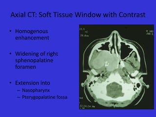 Axial CT: Soft Tissue Window with Contrast
• Homogenous
enhancement
• Widening of right
sphenopalatine
foramen
• Extension into
– Nasopharynx
– Pterygopalatine fossa

 