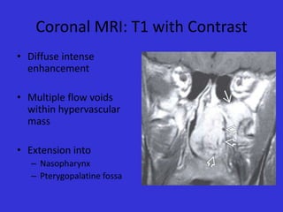 Coronal MRI: T1 with Contrast
• Diffuse intense
enhancement
• Multiple flow voids
within hypervascular
mass
• Extension into
– Nasopharynx
– Pterygopalatine fossa

 