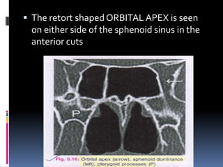  The retort shaped ORBITAL APEX is seen
on either side of the sphenoid sinus in the
anterior cuts
 