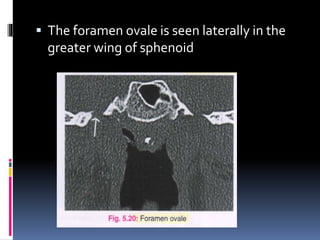 The foramen ovale is seen laterally in the
greater wing of sphenoid
 