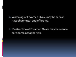 Widening of Foramen Ovale may be seen in
nasopharyngeal angiofibroma.
 Destruction of Foramen Ovale may be seen in
carcinoma nasopharynx.
 