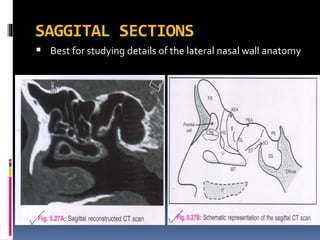 SAGGITAL SECTIONS
 Best for studying details of the lateral nasal wall anatomy
 