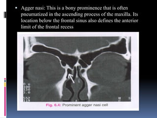  Agger nasi: This is a bony prominence that is often
pneumatized in the ascending process of the maxilla. Its
location below the frontal sinus also defines the anterior
limit of the frontal recess
 