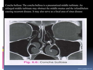 -drdhiru456@gmail.com
Concha bullosa: The concha bullosa is a pneumatized middle turbinate. An
enlarged middle turbinate may obstruct the middle meatus and the infundibulum
causing recurrent disease. It may also serve as a focal area of sinus disease
 
