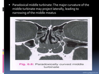 -drdhiru456@gmail.com
 Paradoxical middle turbinate:The major curvature of the
middle turbinate may project laterally, leading to
narrowing of the middle meatus
 