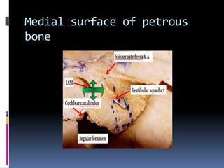 Medial surface of petrous
bone
 