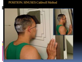 POSITION: SINUSES Caldwell Method
 