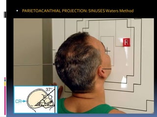  PARIETOACANTHIAL PROJECTION: SINUSESWaters Method
 