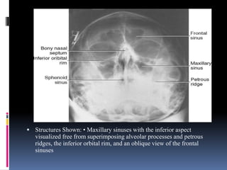  Structures Shown: • Maxillary sinuses with the inferior aspect
visualized free from superimposing alveolar processes and petrous
ridges, the inferior orbital rim, and an oblique view of the frontal
sinuses
 