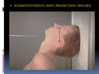  SUBMENTOVERTEX (SMV) PROJECTION: SINUSES
 