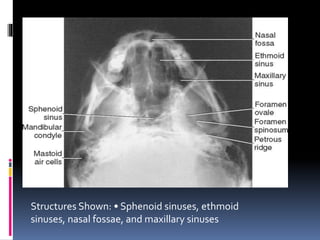 Structures Shown: • Sphenoid sinuses, ethmoid
sinuses, nasal fossae, and maxillary sinuses
 