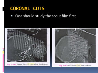 CORONAL CUTS
 One should study the scout film first
 