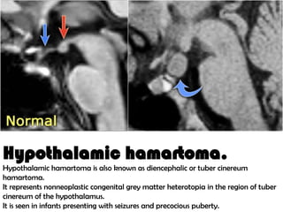 IMAGING IN EPILEPSYbj,jhh,sdd,h,jhvbhs,hfvb,jfgr | PPTX
