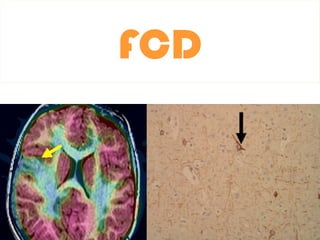 IMAGING IN EPILEPSYbj,jhh,sdd,h,jhvbhs,hfvb,jfgr | PPTX