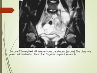 Imaging in female infertility | PPTX