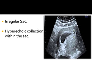  Irregular Sac.
 Hyperechoic collection
within the sac.
 
