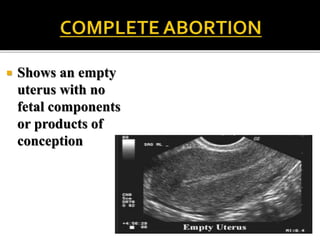  Shows an empty
uterus with no
fetal components
or products of
conception
 