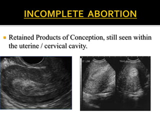  Retained Products of Conception, still seen within
the uterine / cervical cavity.
 