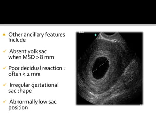  Other ancillary features
include
 Absent yolk sac
when MSD > 8 mm
 Poor decidual reaction :
often < 2 mm
 Irregular gestational
sac shape
 Abnormally low sac
position
 