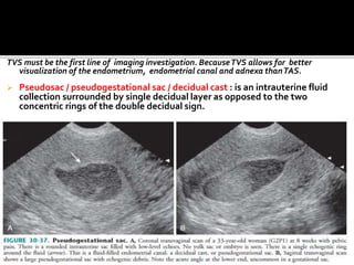 TVS must be the first line of imaging investigation. BecauseTVS allows for better
visualization of the endometrium, endometrial canal and adnexa thanTAS.
 Pseudosac / pseudogestational sac / decidual cast : is an intrauterine fluid
collection surrounded by single decidual layer as opposed to the two
concentric rings of the double decidual sign.
 