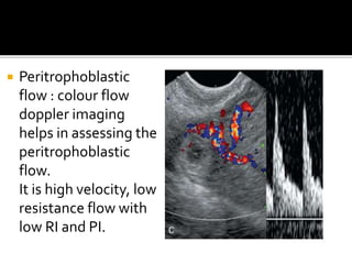  Peritrophoblastic
flow : colour flow
doppler imaging
helps in assessing the
peritrophoblastic
flow.
It is high velocity, low
resistance flow with
low RI and PI.
 